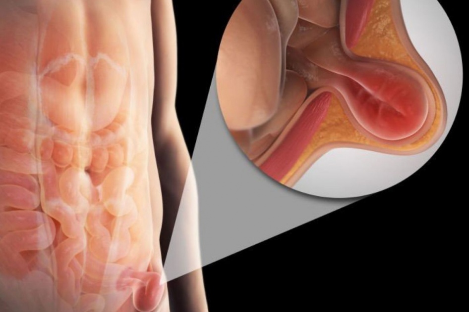 Mapa das hérnias: entenda as diferentes hérnias abdominais.