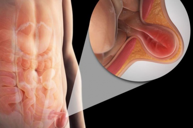Mapa das hérnias: entenda as diferentes hérnias abdominais.