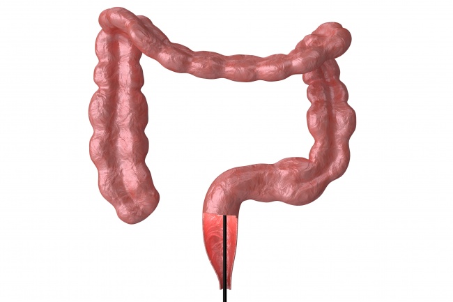 Tenho histórico familiar de pólipos intestinais. Devo adiantar a colonoscopia?