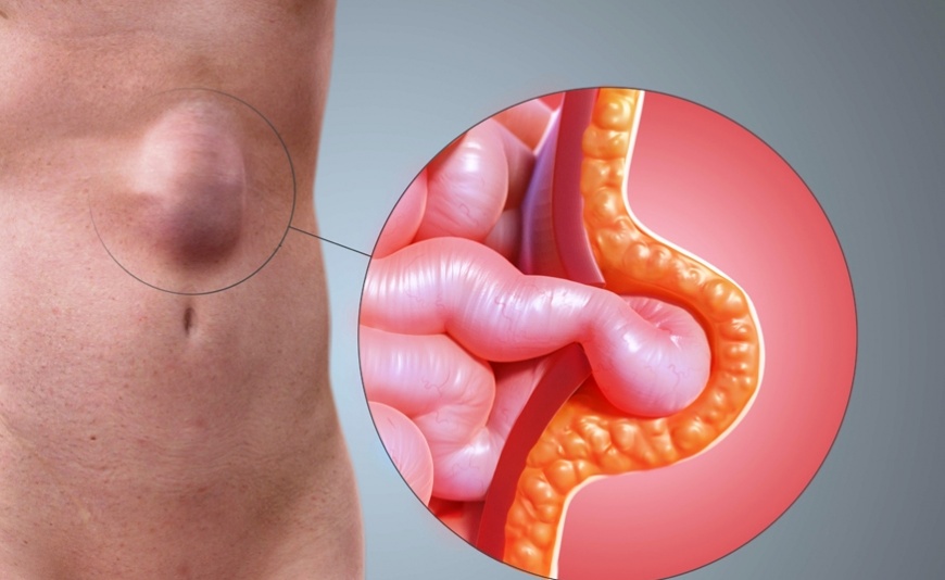 Hérnias Parede Abdominal